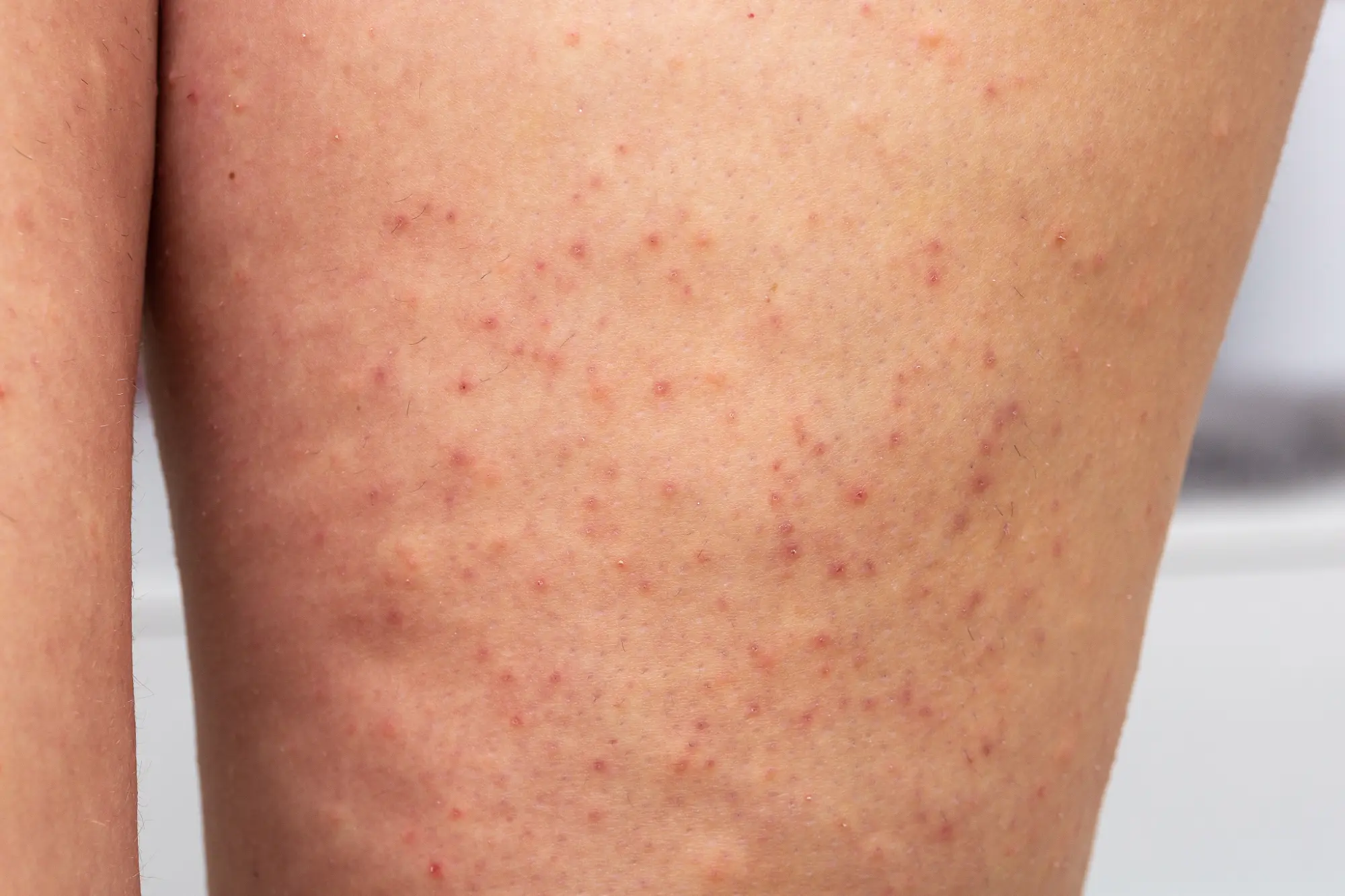An example of Keratosis Pilaris that can be treated at Biltmore Dermatology